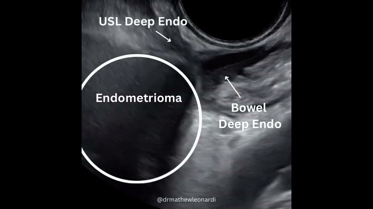 Endometriosis adhesions involving bowel and ovary #ultrasound #endometriosis #gynecologicsurgery