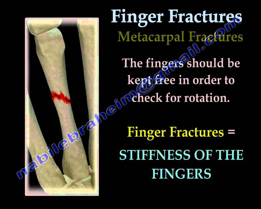 Finger and metacarpal Fractures - Everything You Need To Know - Dr. Nabil Ebraheim