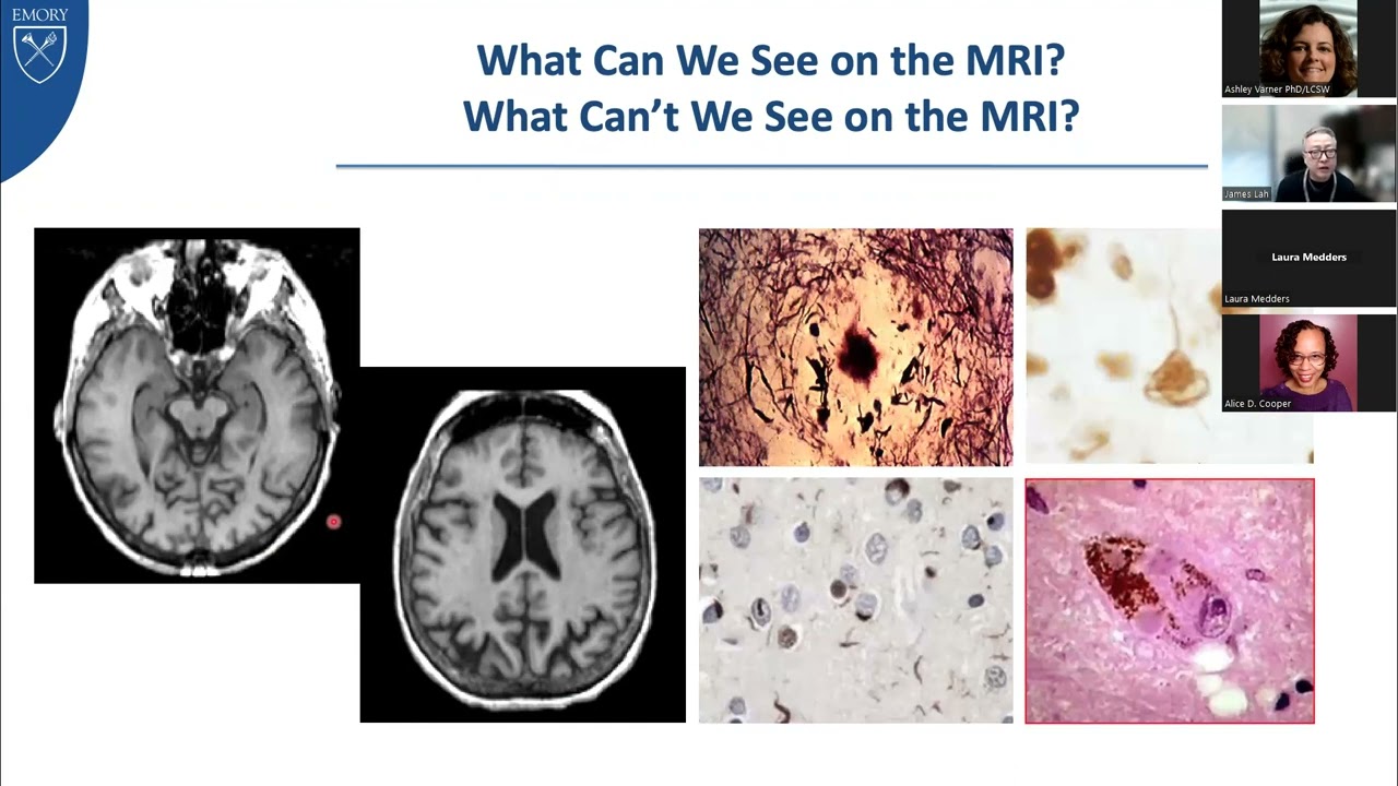 Overview of Mild Cognitive Impairment and Different Dementias