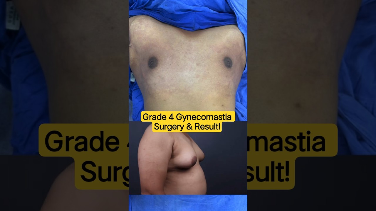 Severe Man Boobs (Grade 4) &ndash; Best Surgical Solution Gynecomastia | Dr DC Plastic Surgeon Pune