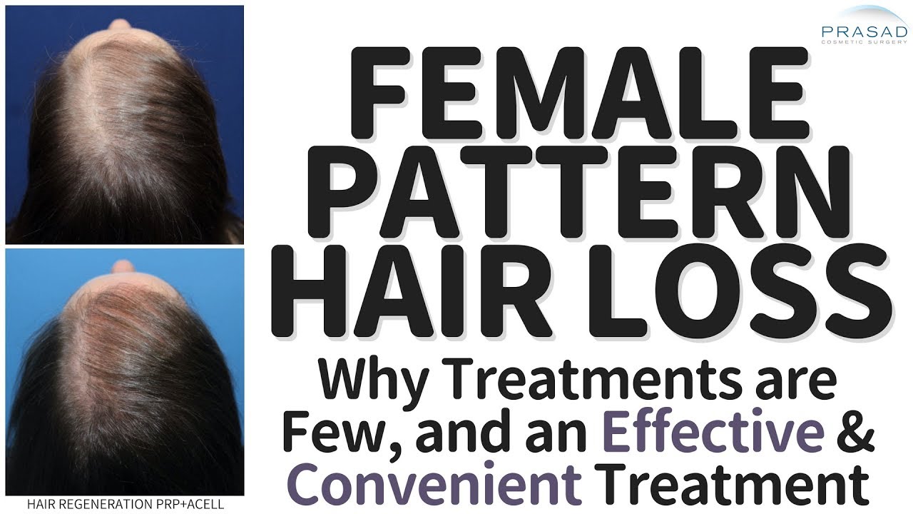 What You Need to Know About Causes of Hair Loss in Women, and Treating Female Pattern Hair Loss