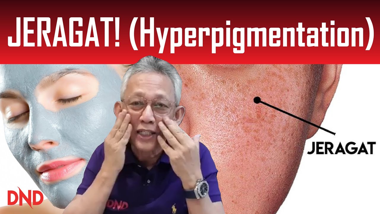 JERAGAT! (hyperpigmentation) APA NAK BUAT!!