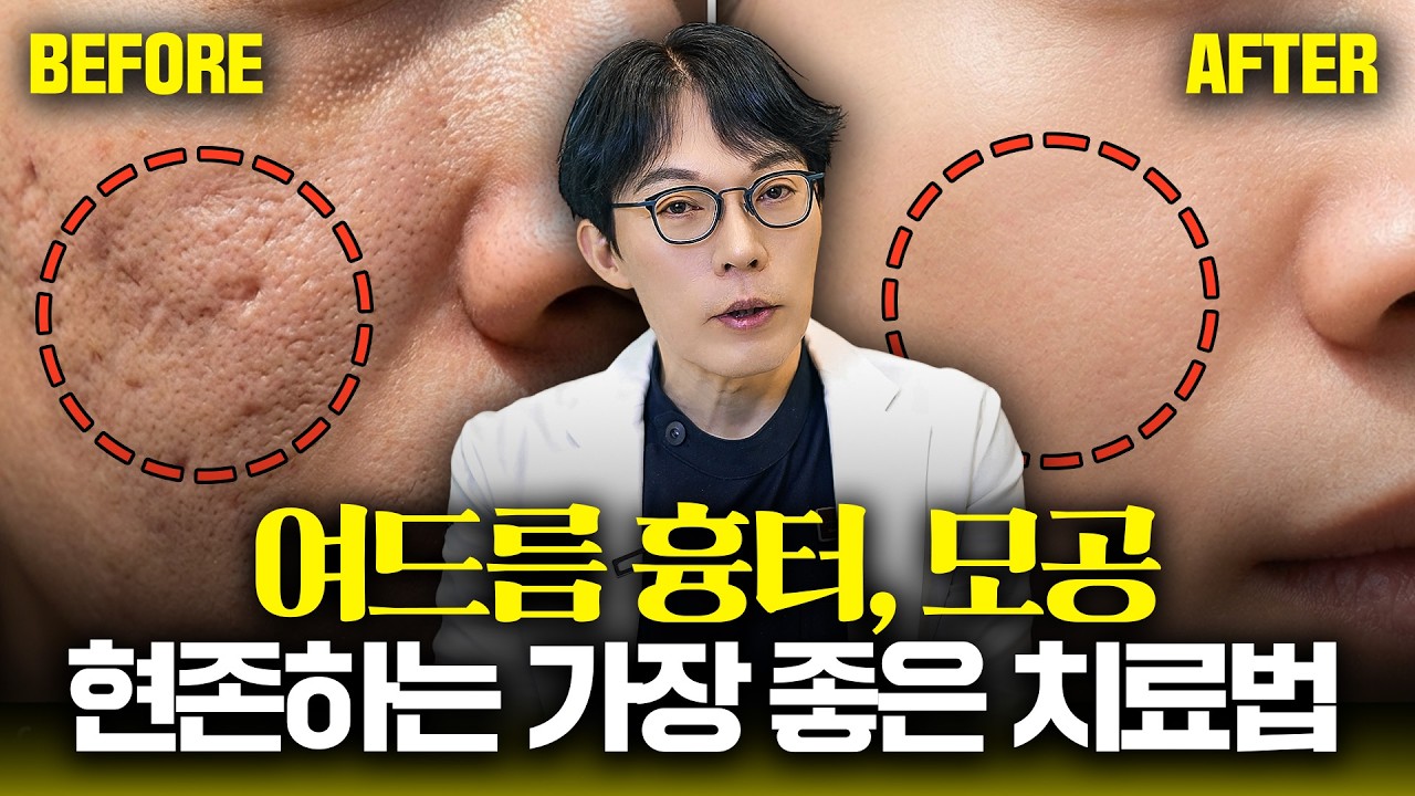 25년차 피부과 전문의가 말하는 여드름 흉터, 모공에 가장 효과좋은 치료법❗