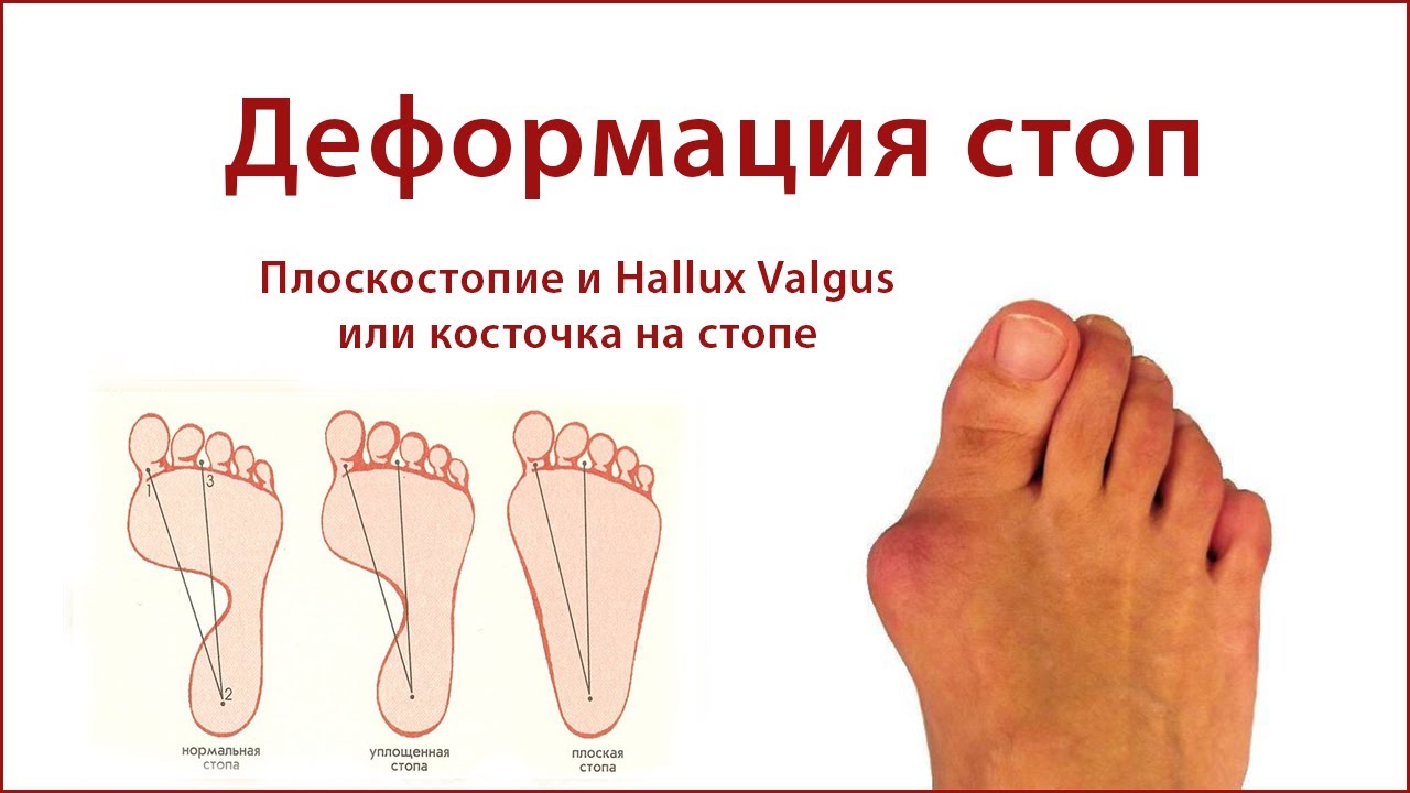 Деформация стоп
