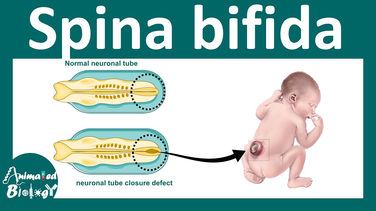 Spina Bifida | What is the main cause of spina bifida? | What are the 3 types of spina bifida?