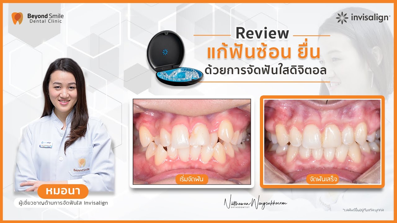 รีวิว before after, ข้อดี ข้อเสีย, การจัดฟันใส Invisalign แก้ฟันซ้อน ยื่น ของหมอนา ที่ Beyond smile