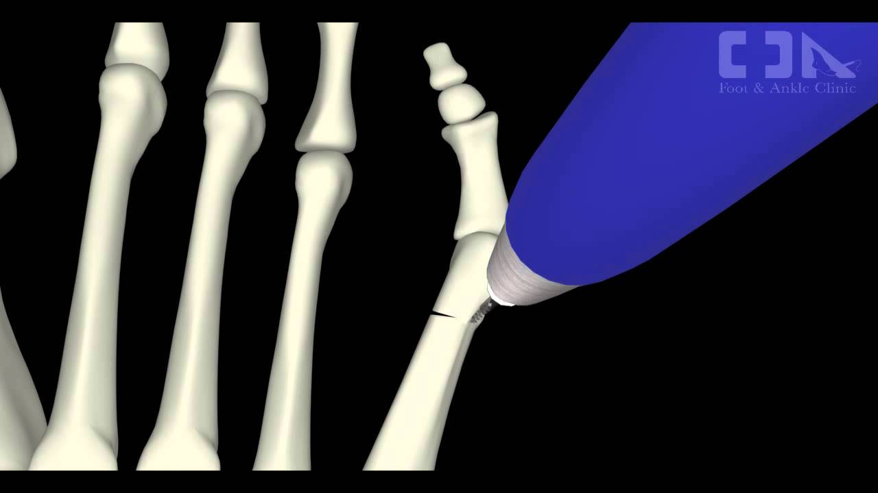 Minimally Invasive Tailor's Bunion Surgery