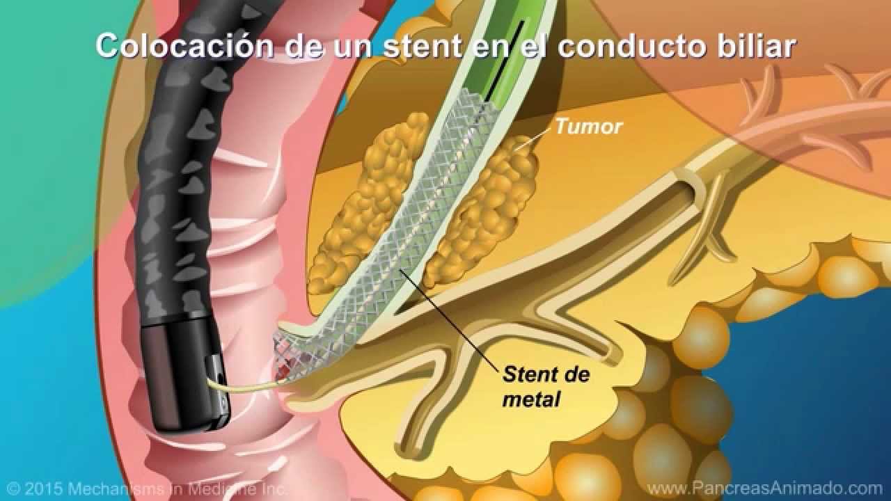 Qué es la colangiopancreatografía retrógrada endoscópica (CPRE)?