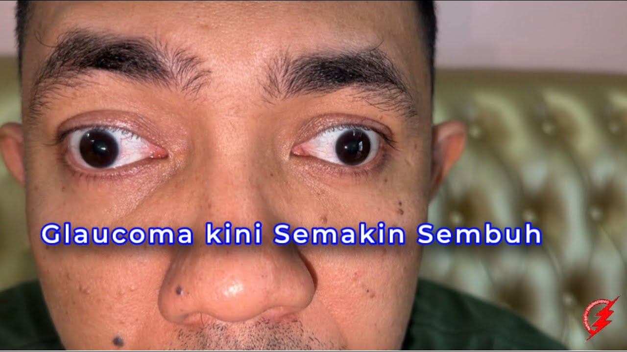 Nur Saraf 4i : Glaucoma kini Semakin Sembuh
