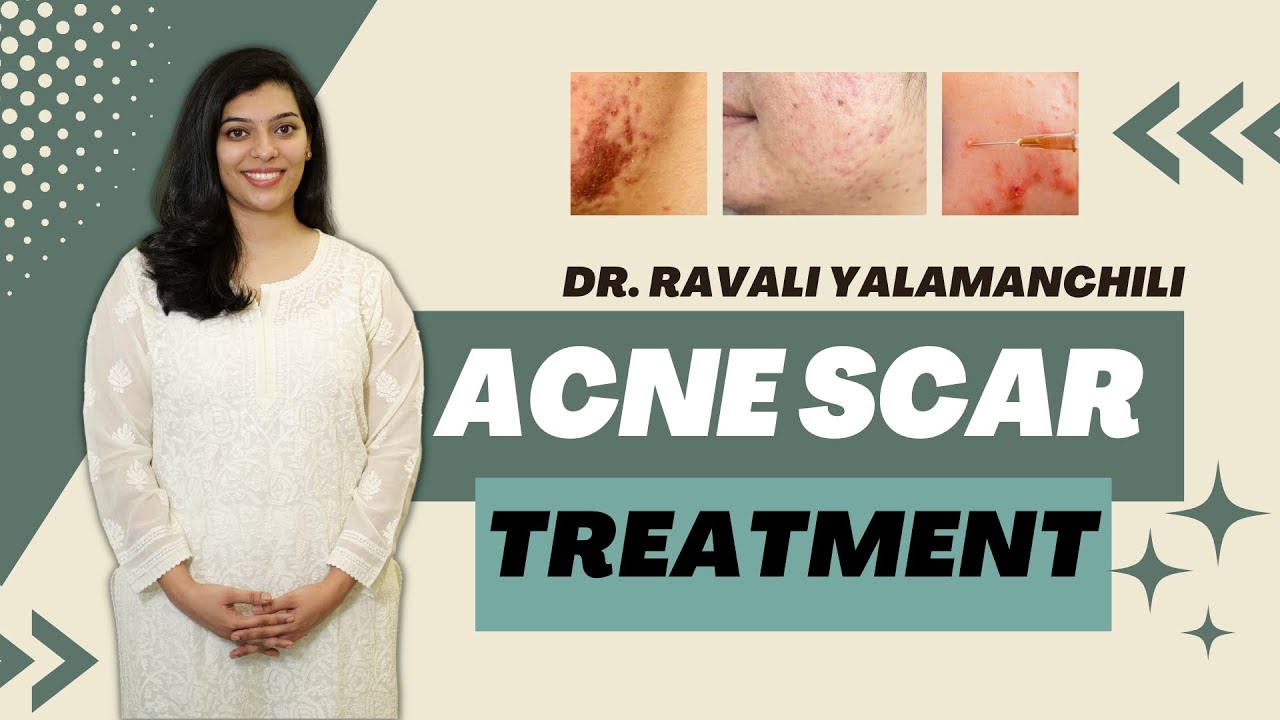 Dermatologist explains Acne scars and it's treatment options | Neya Skin Clinic, Hyderabad