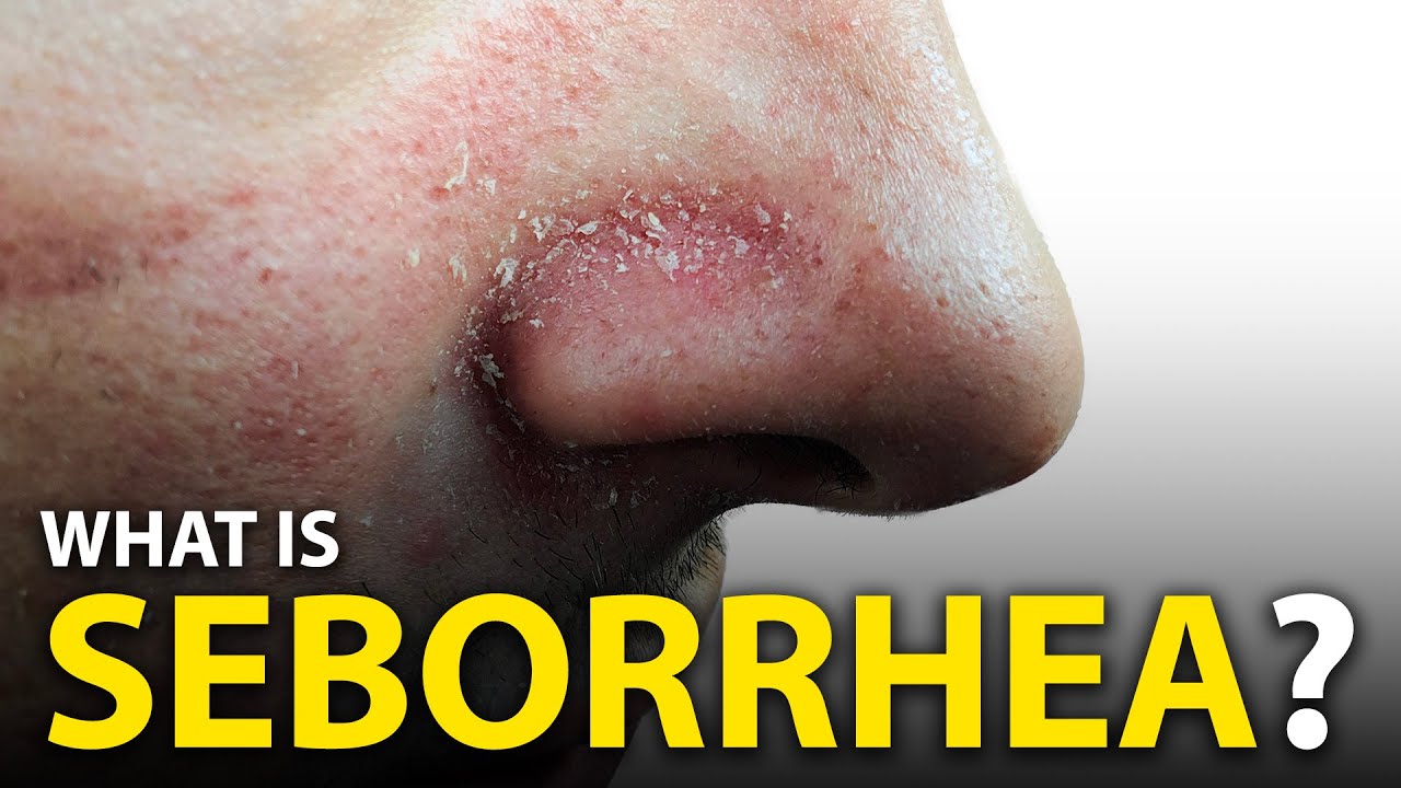 How To Get Rid Of Seborrheic Dermatitis? (DANDRUFF)