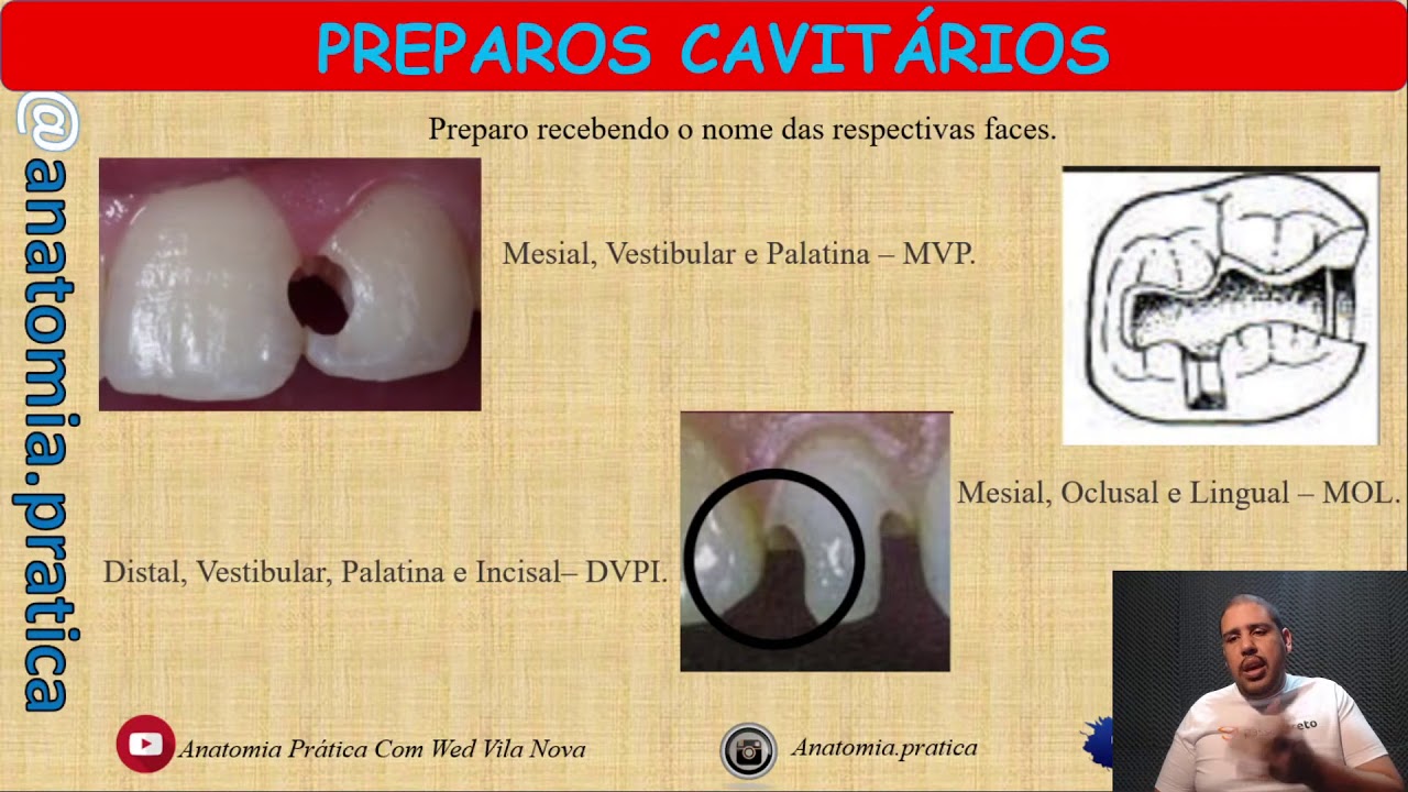 Classificação de Black - Preparo Cavitários - ASB/TSB - Anatomia Prática com Wed Vila Nova