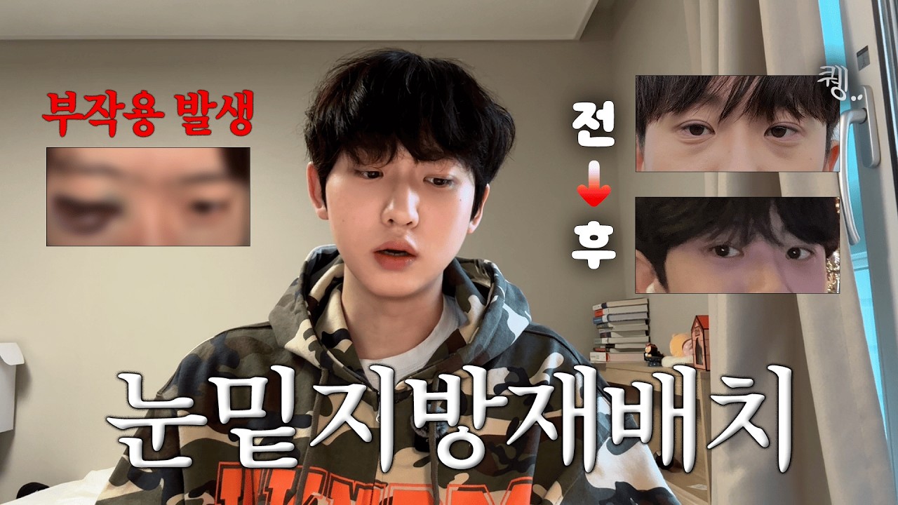 눈밑지방재배치 수술 1년차 후기 + Q&A | 부작용 그리고 재수술...🥵