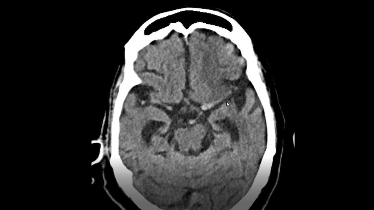 Dense MCA sign on plain CT scan of brain