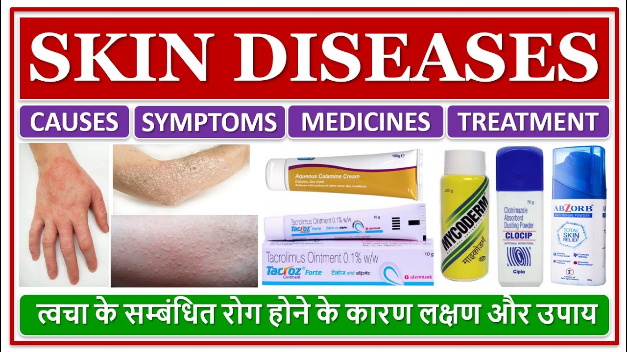 SKIN DISEASES, CAUSES, REASON, TREATMENT, MEDICINE, त्वचा के सम्बंधित रोग होने के कारण लक्षण और उपाय