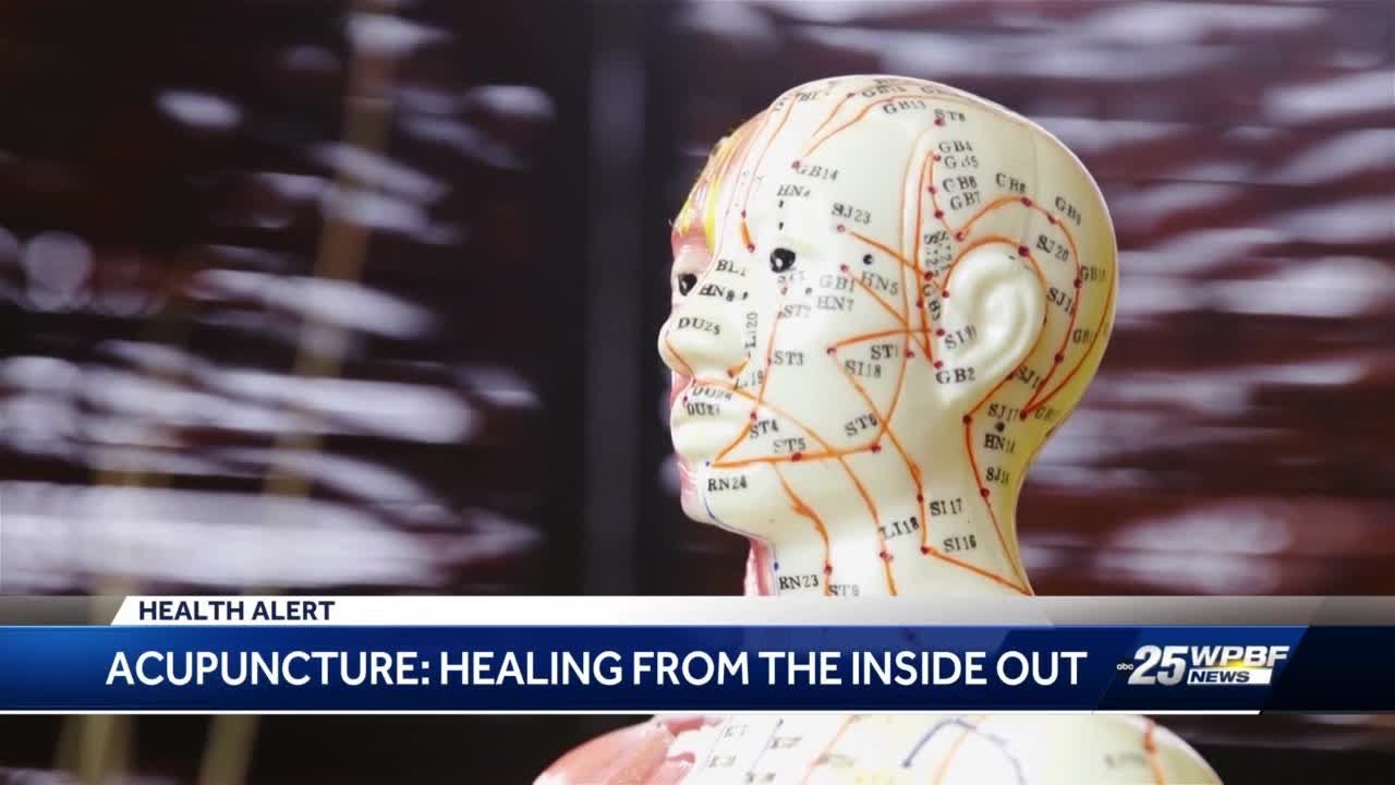 Benefits of acupuncture