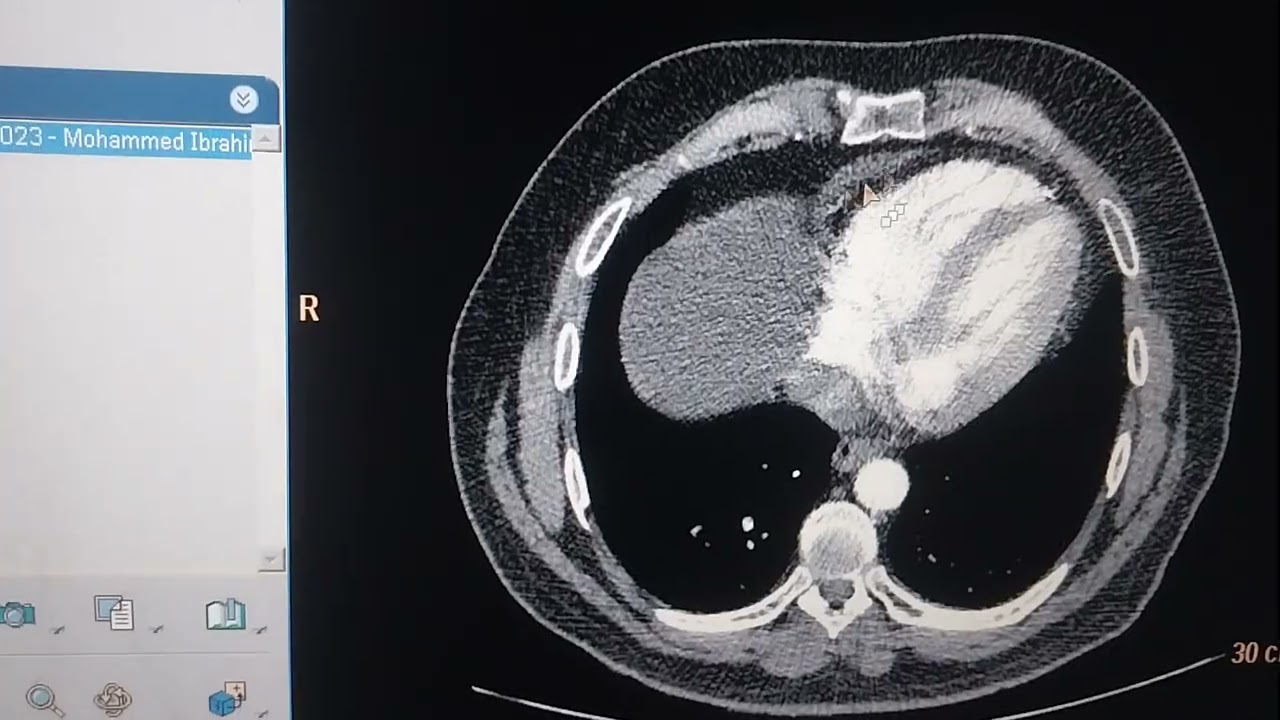 بعض الأخطاء الشائعه في تصوير حالات الشرايين بالأشعه المقطعيه وكيفيه معالجتها