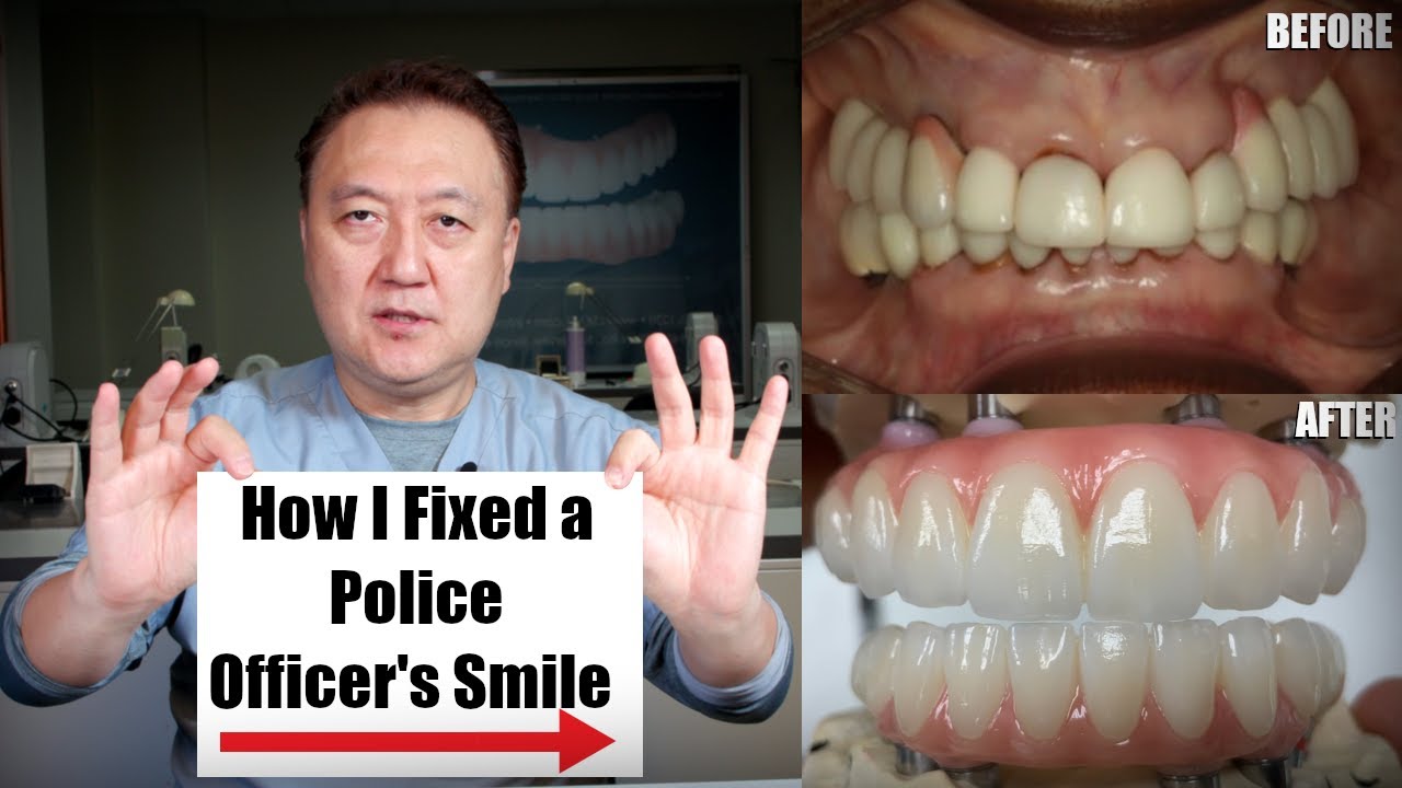 Step-By-Step: How I Fixed a Police Officer's Smile