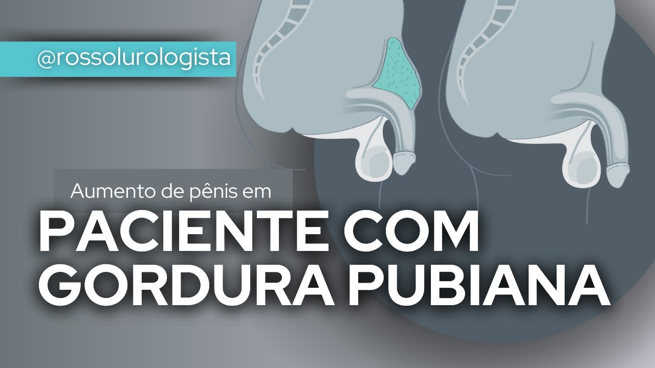 Aumento de pênis em pacientes com gordura pubiana| DR ALESSANDRO ROSSOL
