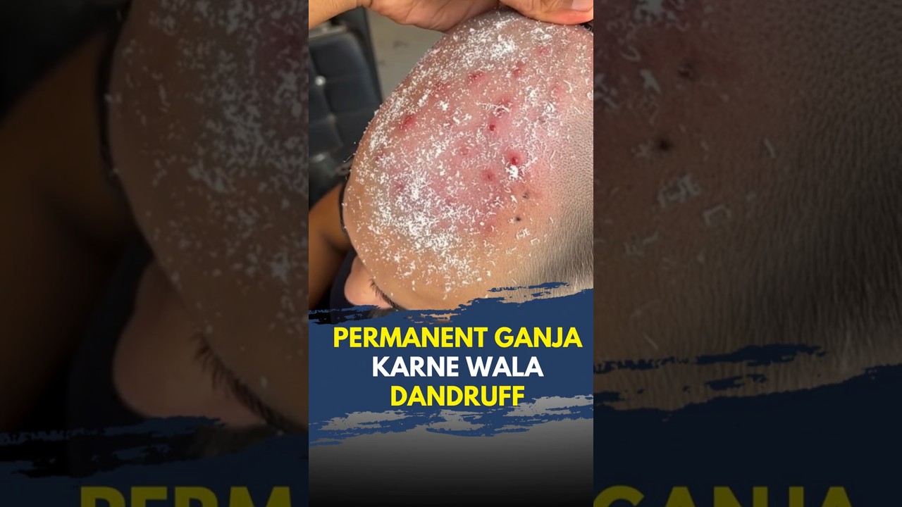 Dandruff control in 15 days | Scalp psoriasis | Hair loss | Hair regrowth #waidonAI #viral #shorts