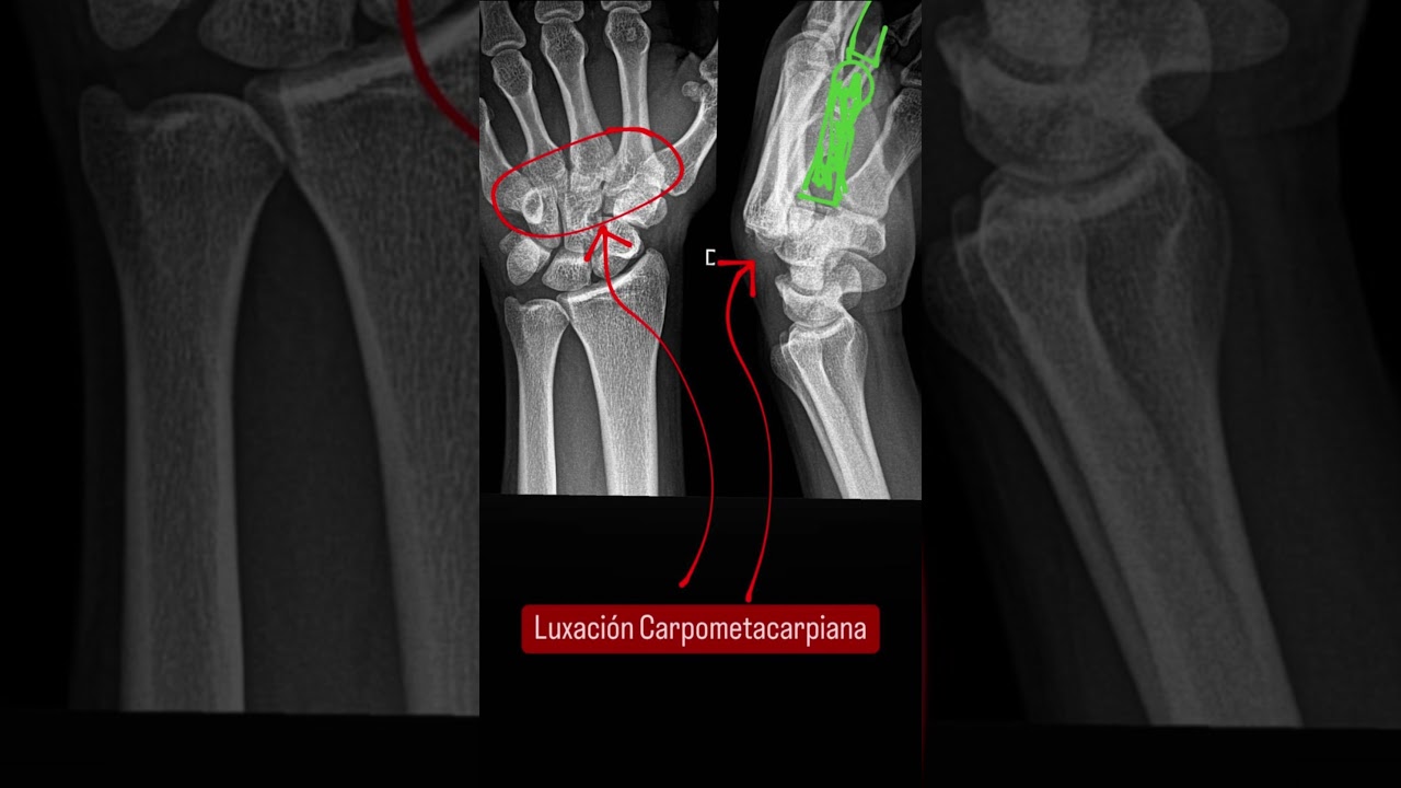#luxacion #carpo #metacarpo #mano #radiografia #radiologia #rayosx #medical