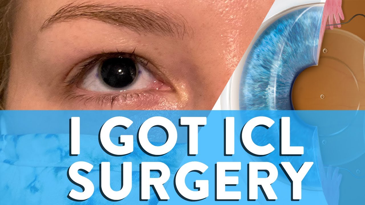 I Got ICL Surgery! My Video Walk-Through Of Entire ICL Surgery Experience. NO LASIK!