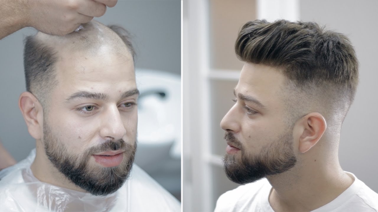 PROTEZ SAÇ - Hair Replacement