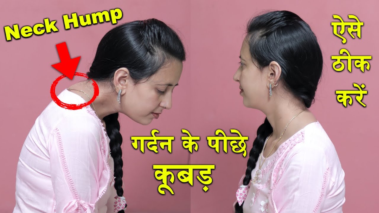 Neck Hump, Correct Posture | Neck Hump Fat Loss Exercises | Healthcity