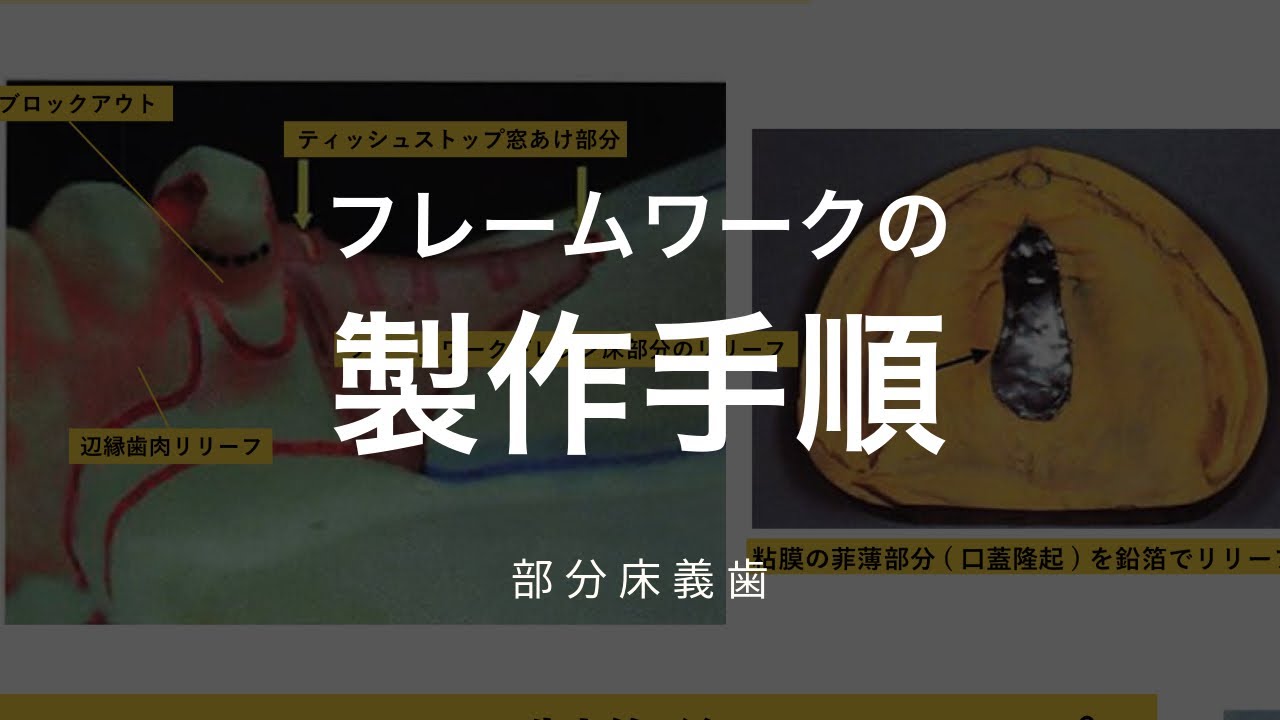 フレームワークの製作手順(複印象と耐火模型について)