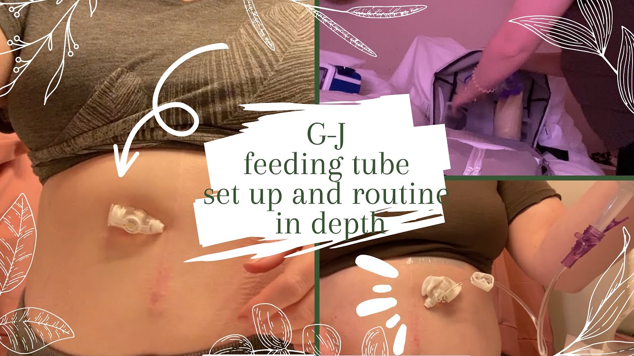 How I set up my FEEDING TUBE in depth MUC-KEY button | G-J feeding tube | feeding tube backpack