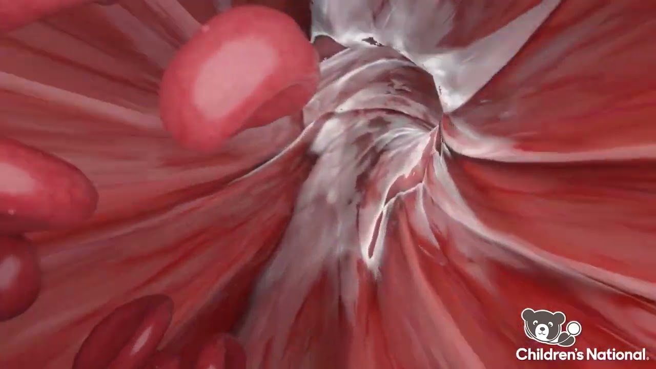 Walking Through A Peripheral Blood Stem Cell (PBSC) Harvest