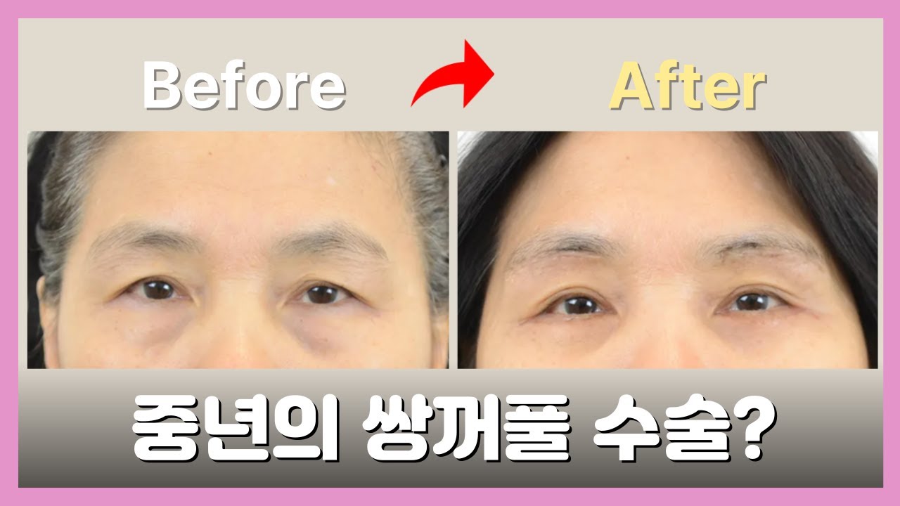 처진 중년의 눈가, 쌍수로 완전히 달라질까?