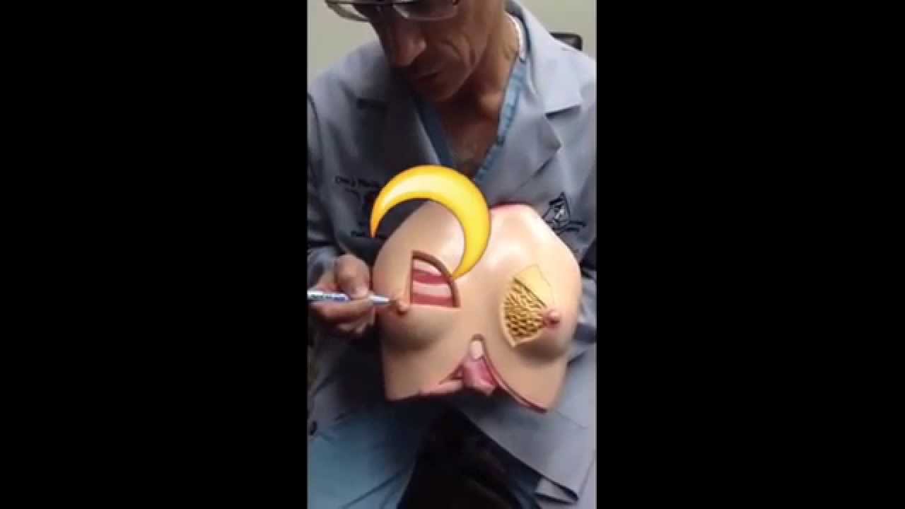 The Periareolar Lift 09.21.15