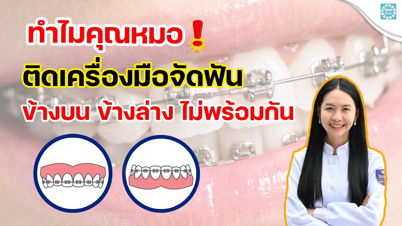 ทำไมคุณหมอติดเครื่องมือจัดฟัน ข้างบน ข้างล่าง ไม่พร้อมกัน!!