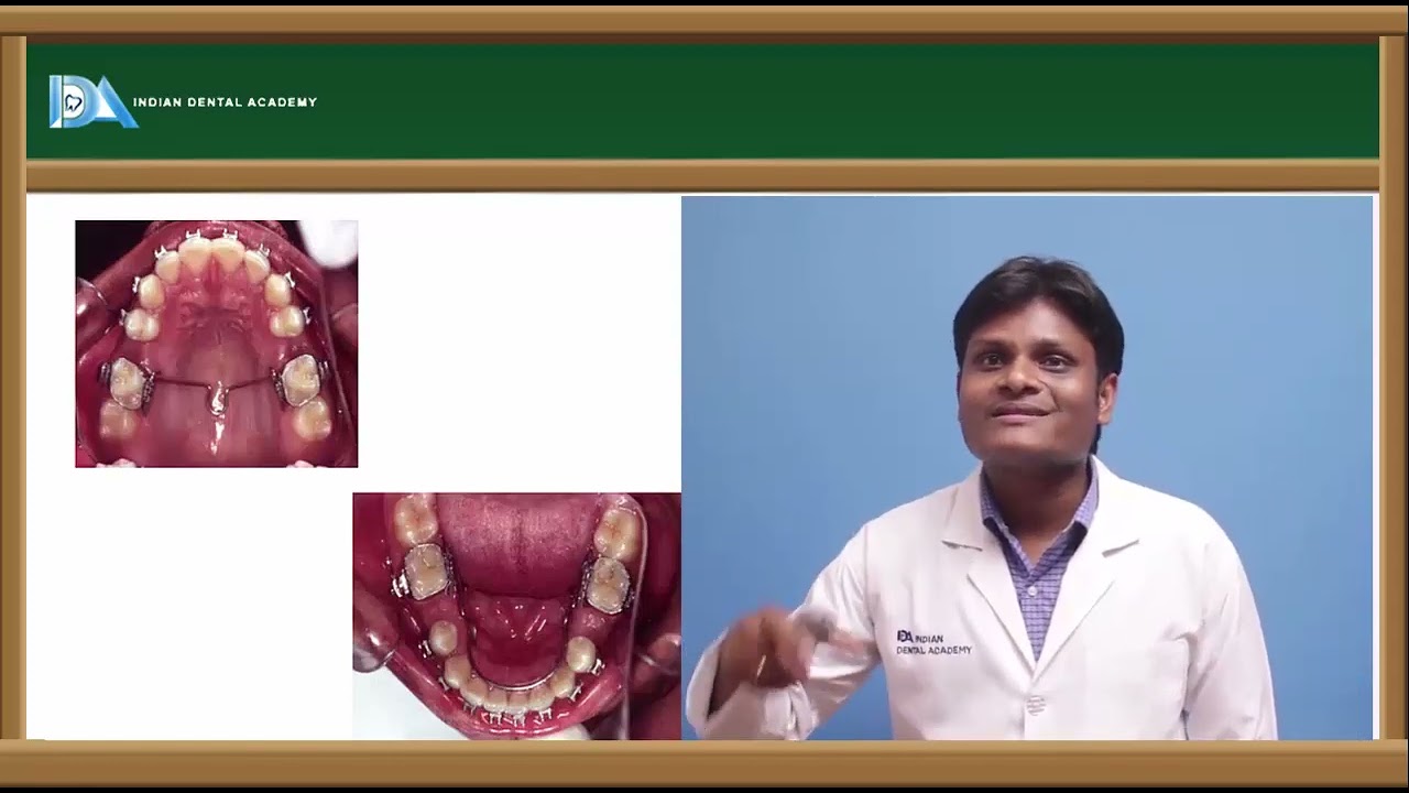 Extraction in orthodontics | #NEET#MDS#BDS#NBDE#ORE#DDS