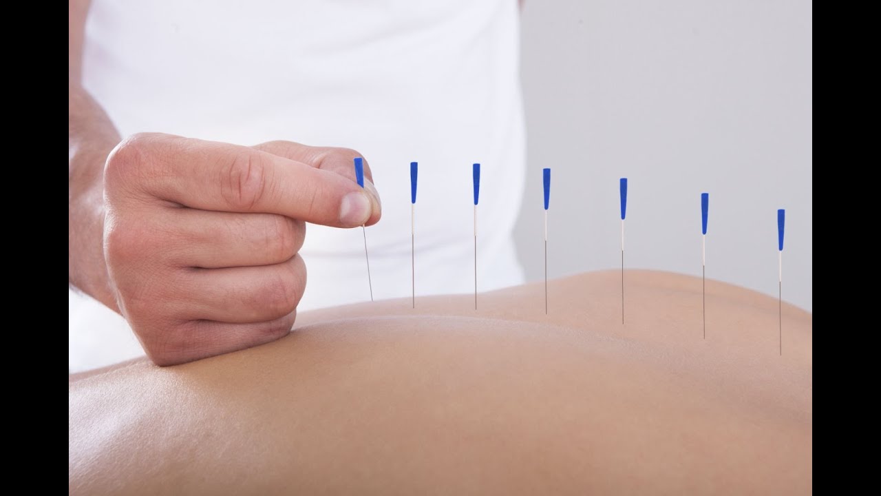 Acupuncture 101