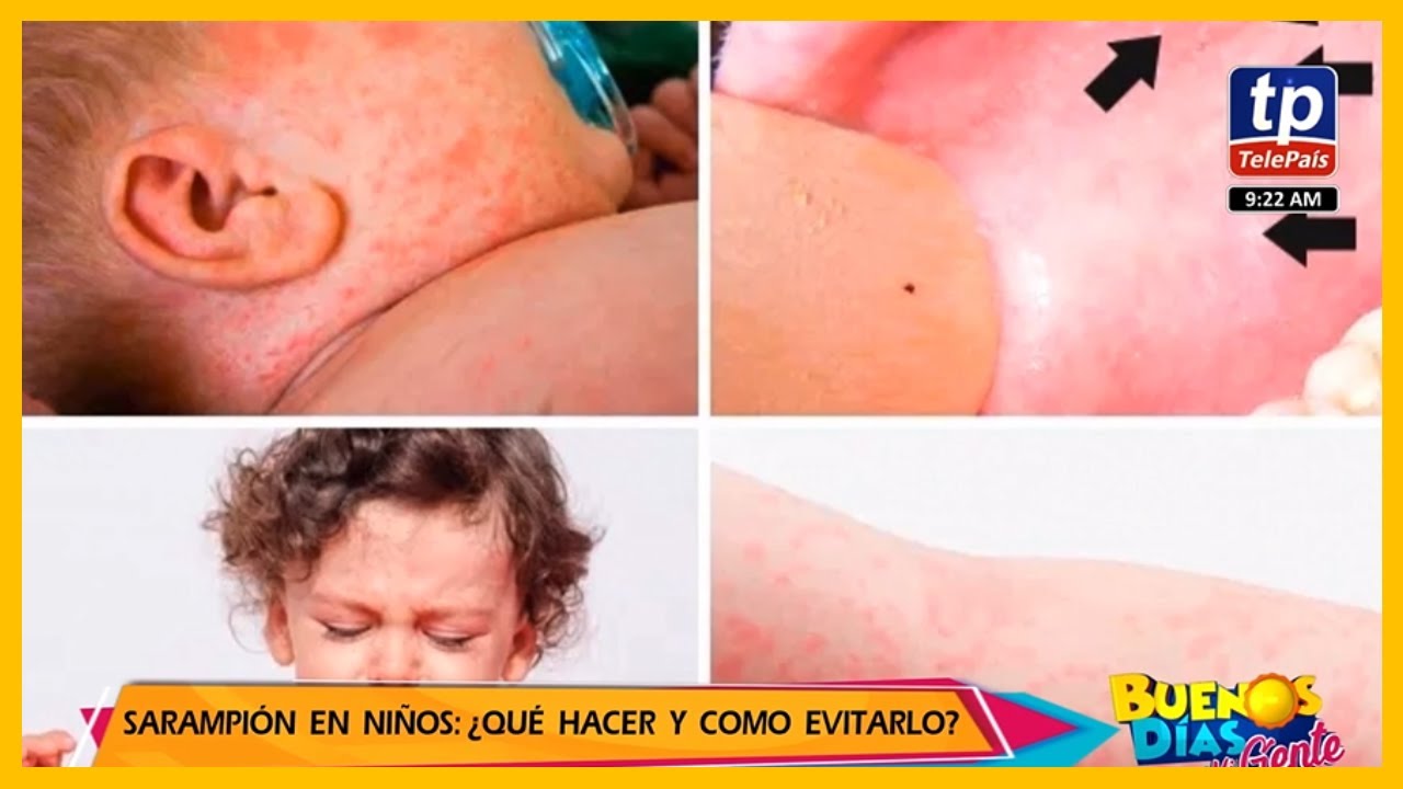 Sarampión en niños: ¿Qué hacer y Como evitarlos?