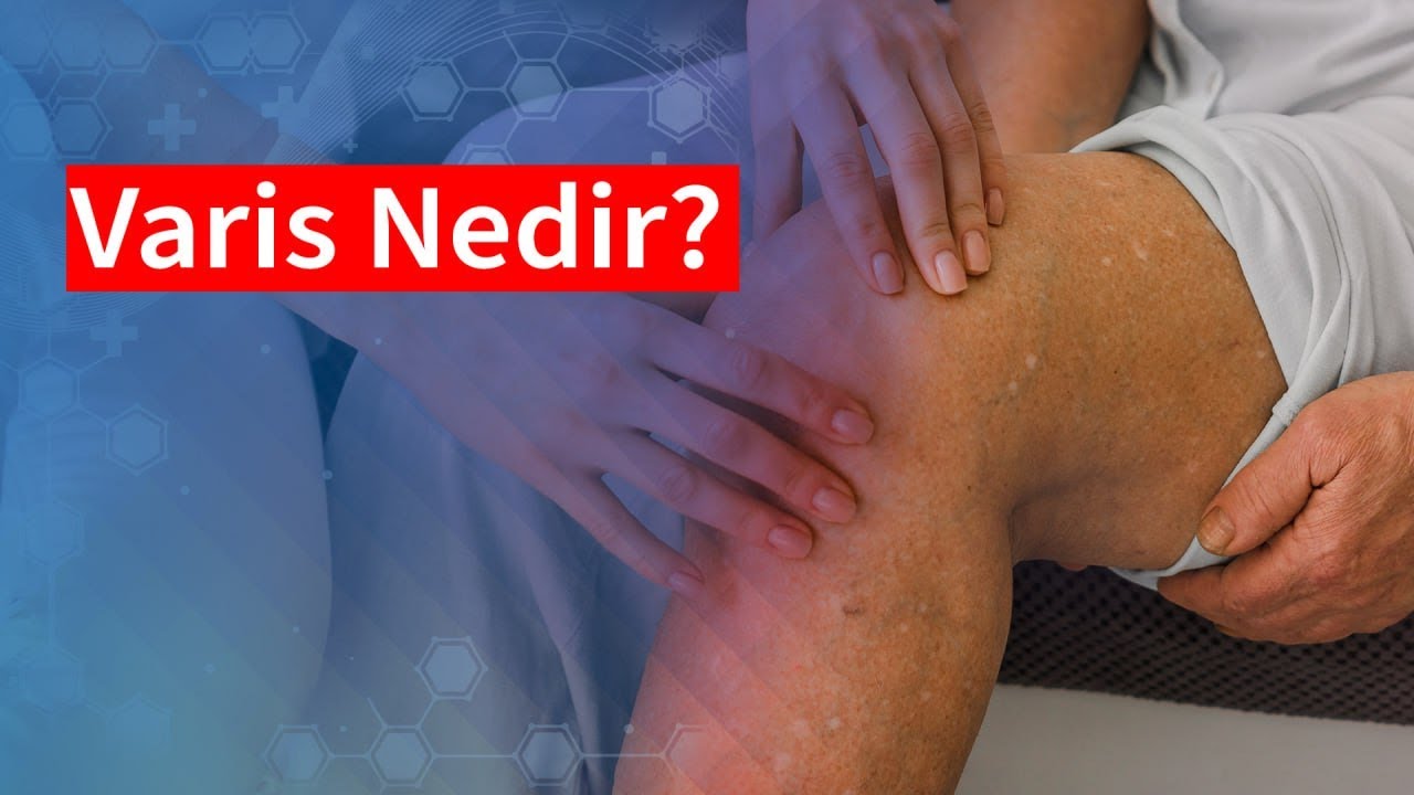 Varis Nedir? | Medical Park