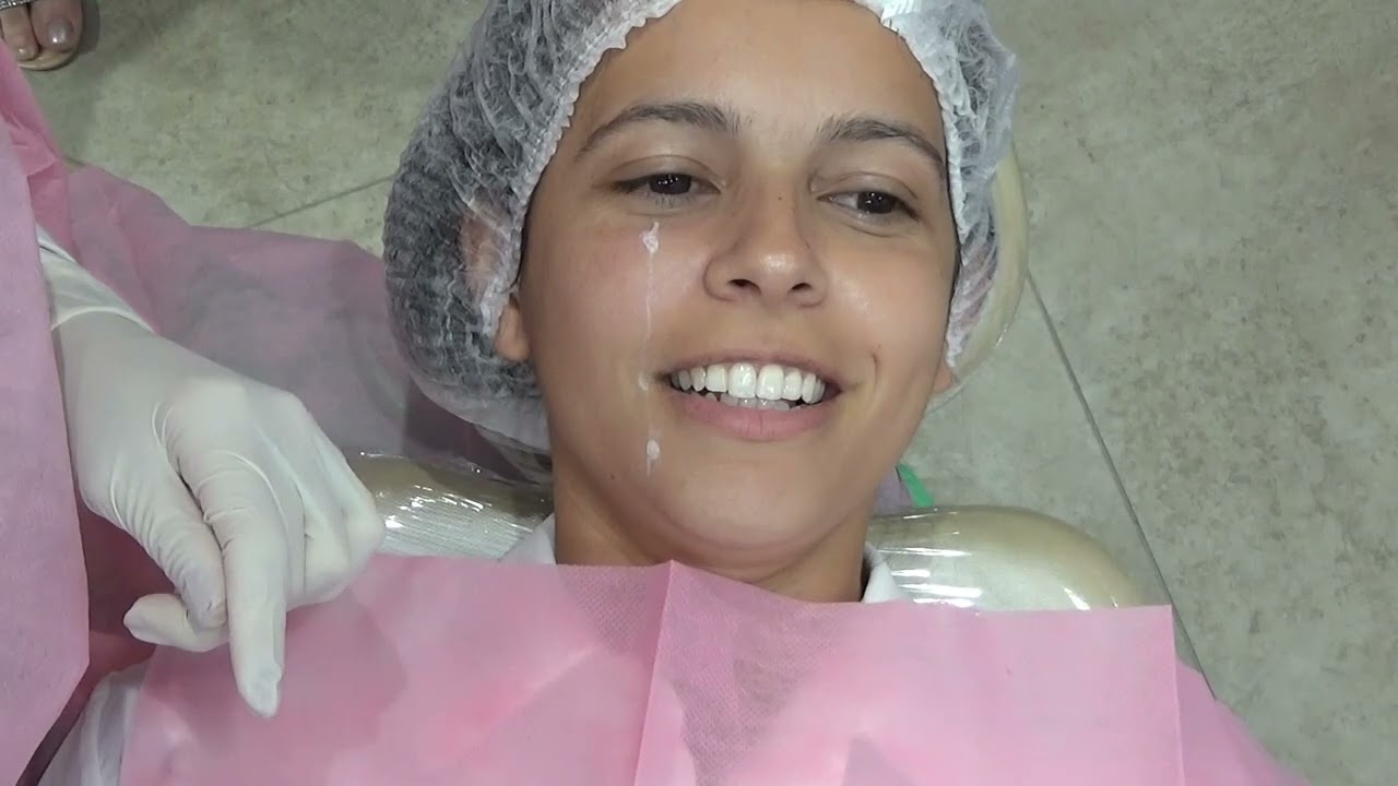 preenchimento labial com c&acirc;nula