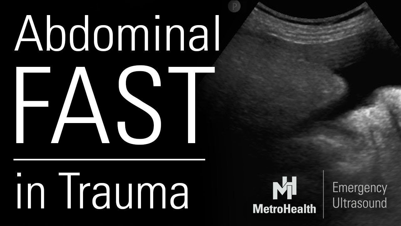 The Abdominal FAST
