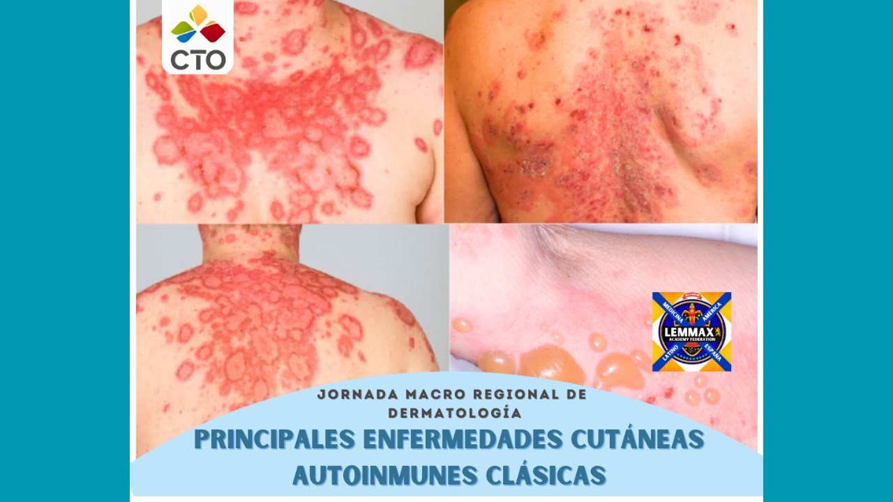 JMR DERMATOLOGÍA - S1: LUPUS ERITEMATOSO SISTÉMICO - DR. ROJAS ÁLVARO