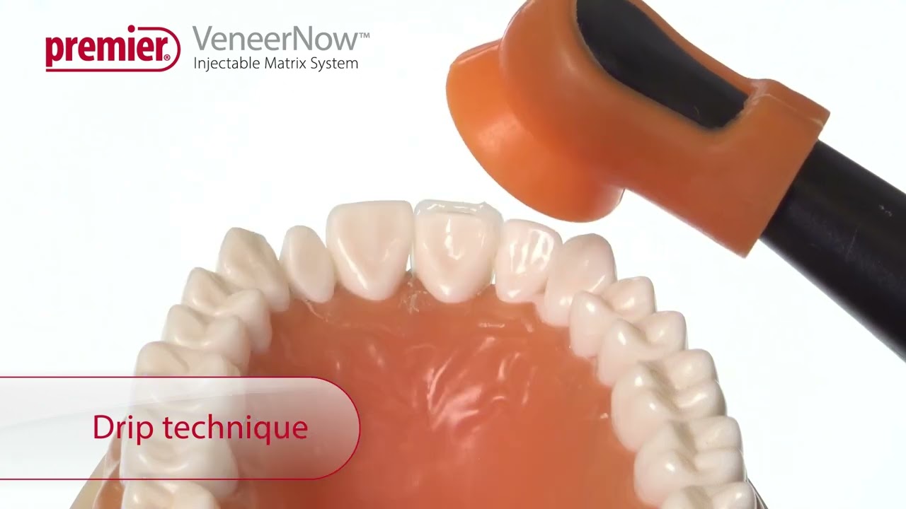 VeneerNow™ Injectable Matrix System - Optimize the VeneerNow™ Workflow