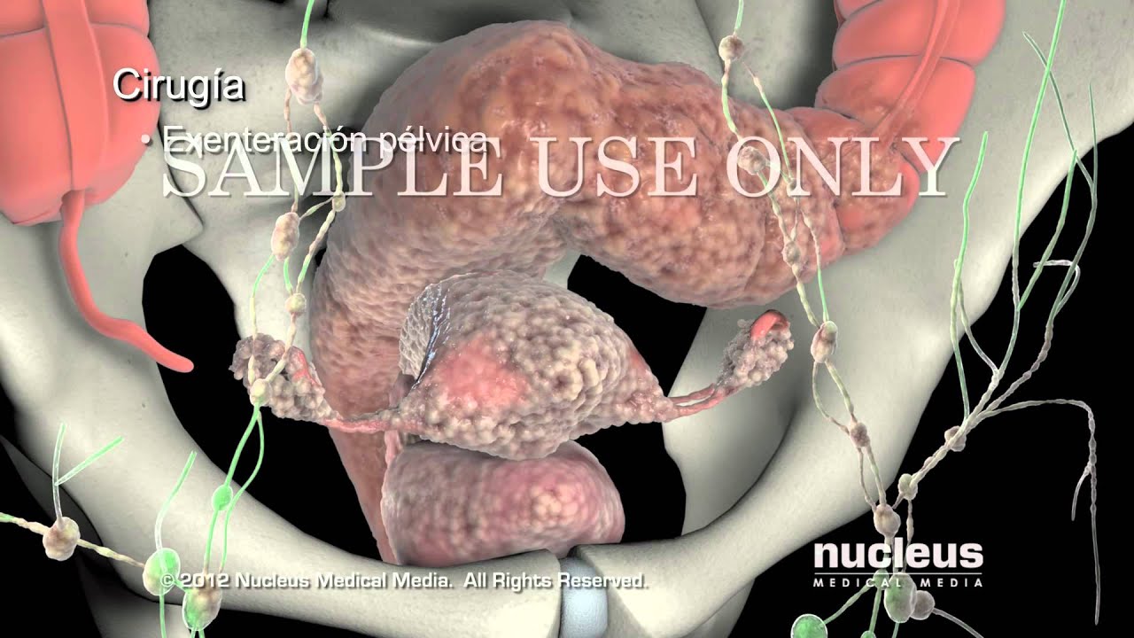 Tratamientos para el cáncer de cuello uterino