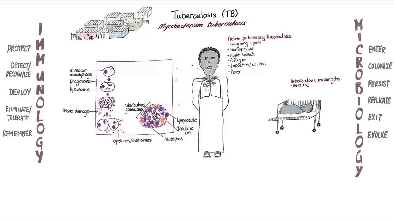 Tuberculosis: Springboard