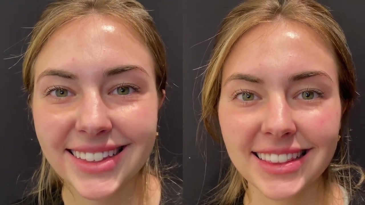 Live RHA Filler Under Eye, Cheeks & Lips Treatments | Austin Plastic Surgeon | Austin, TX