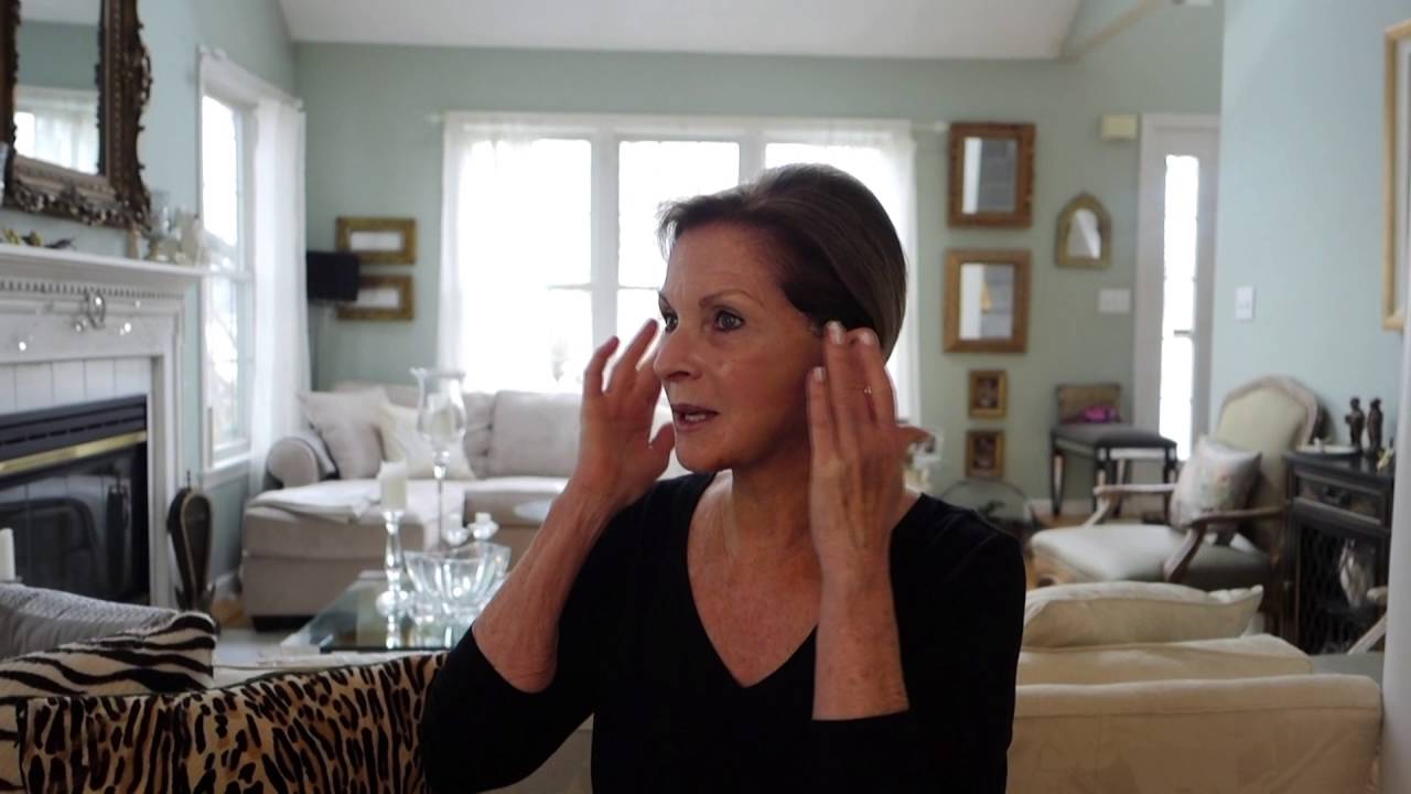 Paula 6 days after her Lower Face/Neck Lift: Min S. Ahn MD FACS
