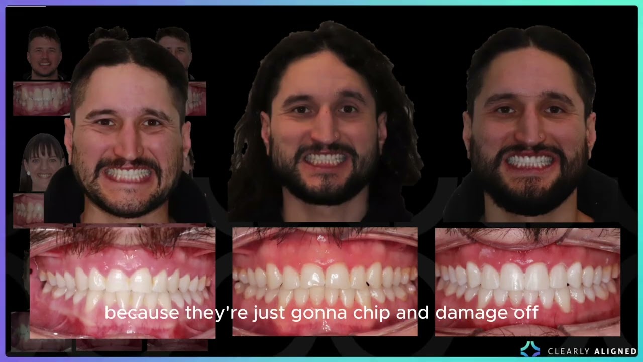 Why Do Invisalign?