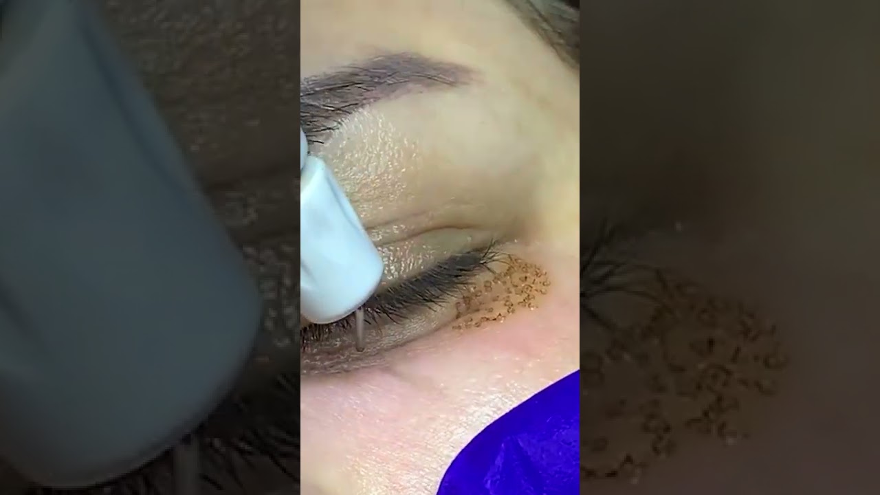 PLEXR Eye Lid Tightening &ndash; niechirurgiczna blefaroplastyka! #shorts #DrBurhanClinic