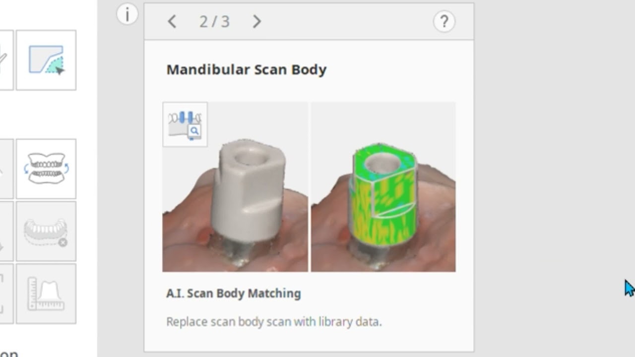 Implant Supported Denture Scan (ENG)