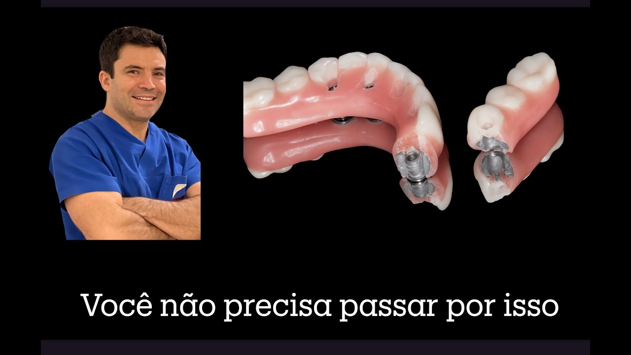 Cantilever Seguro